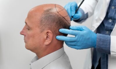 Hair Transplantation