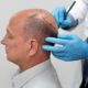 Hair Transplantation