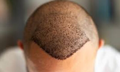 turkey hair transplant