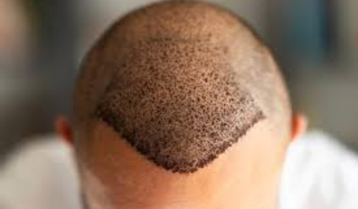 turkey hair transplant